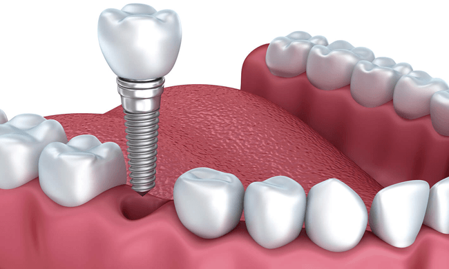 Cấy ghép Implant